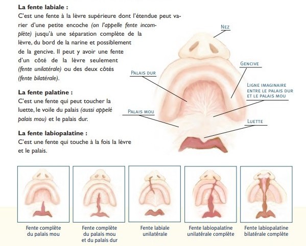 Fente_labiopalatine.jpg