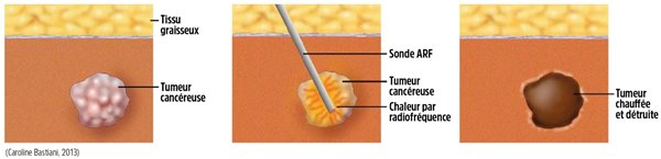 Élimination de tumeur par radiofréquence