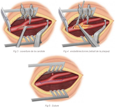 Étapes de la chirurgie