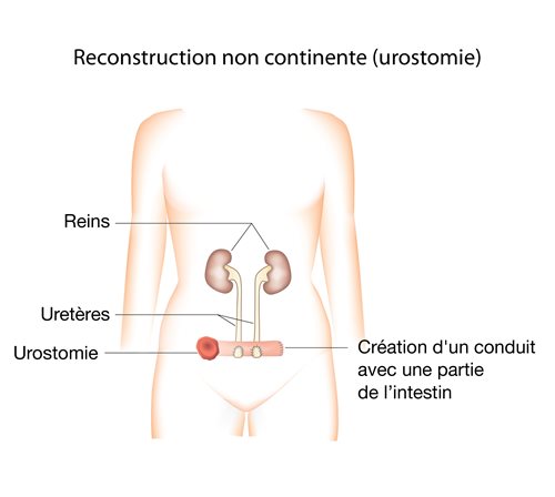 Reconstruction non continente (urostomie)